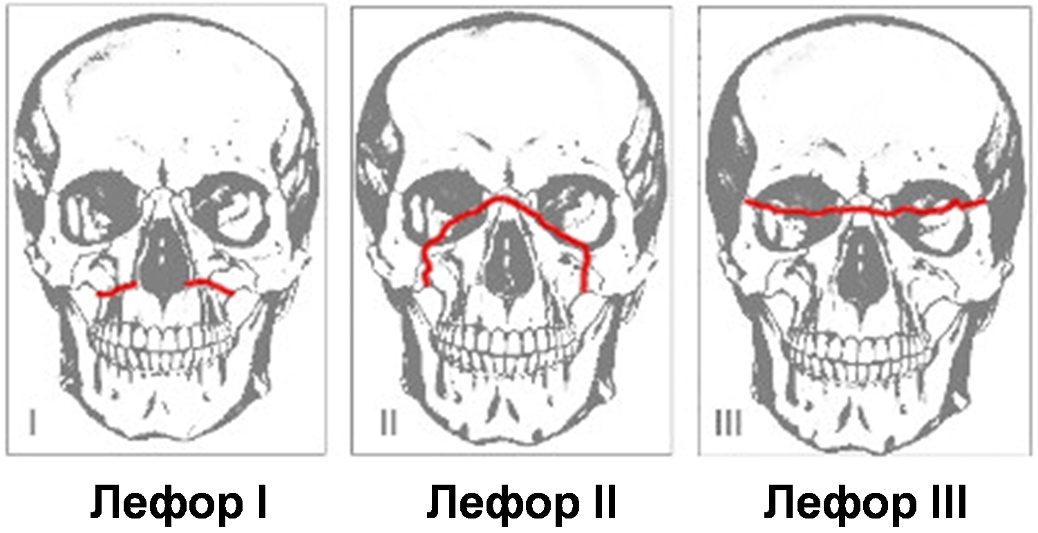 Перелом лицевого черепа. Лефор классификация переломов верхней челюсти. Суббазальный перелом верхней челюсти Лефор. Переломы верхней челюсти по Лефор 1.