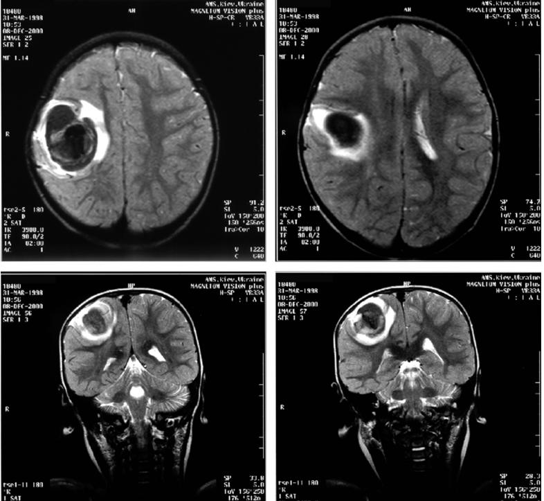Гематома головного мозга мрт. Хроническая внутримозговая гематома мрт. Мрт головного мозга расшифровка снимков.